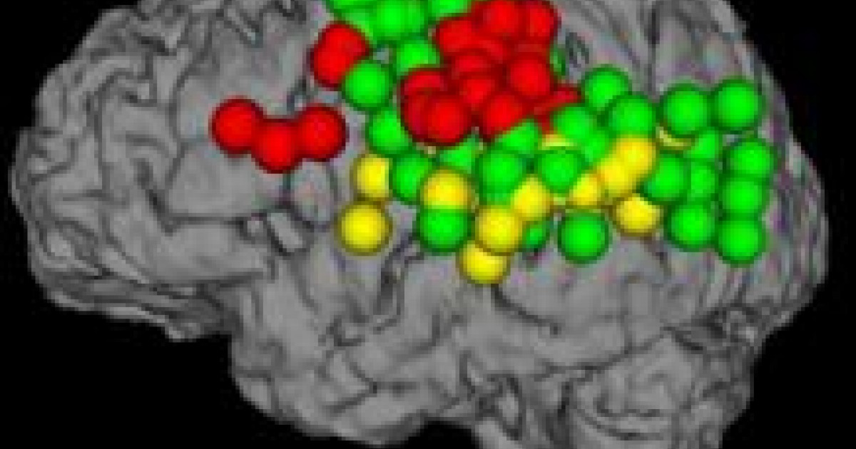 Brain Swelling From Large Hemispheric Infarctions Department Of Neurology The University Of 3428